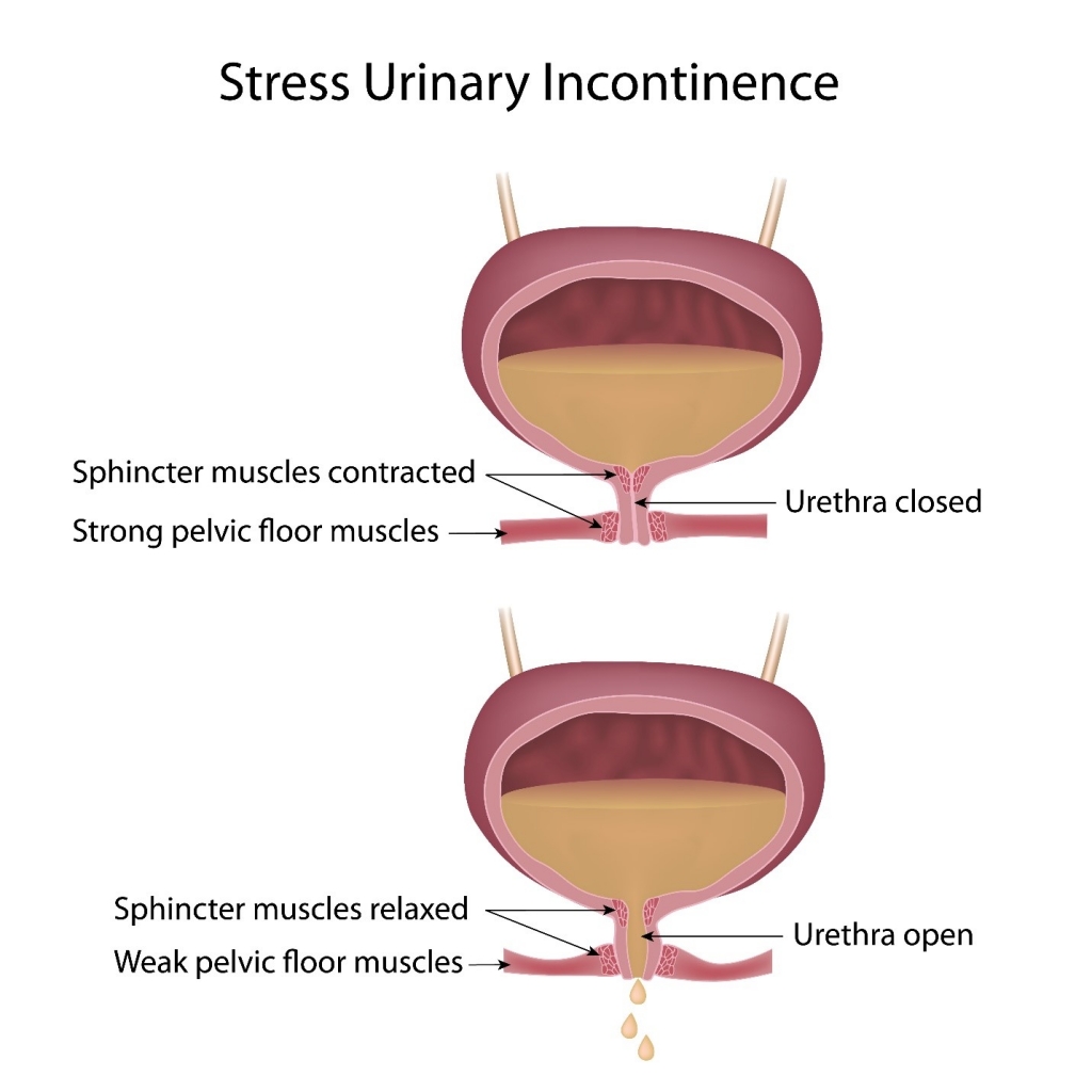 Managing Vs Treating Urinary Incontinence UI Pericoach